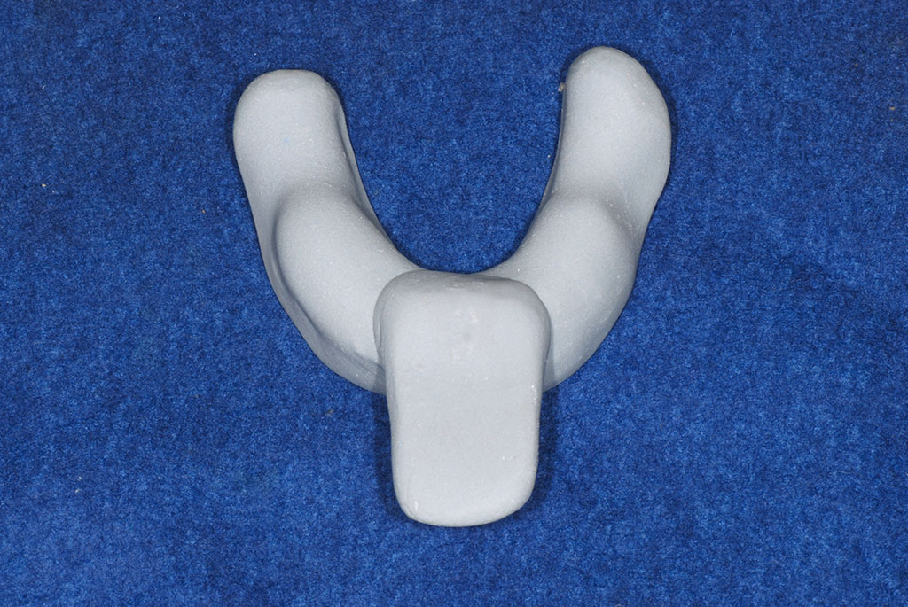 薬円台・古池歯科・口腔内の形態が複雑な際に製作