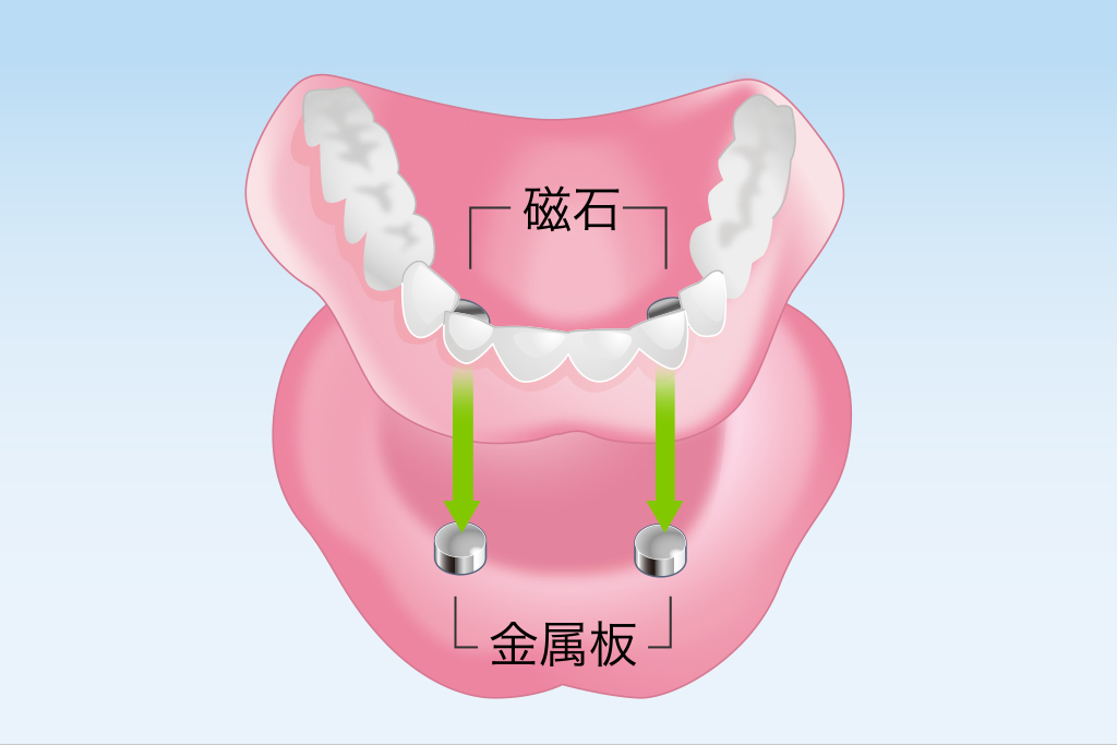 薬円台・古池歯科・磁性アタッチメント義歯