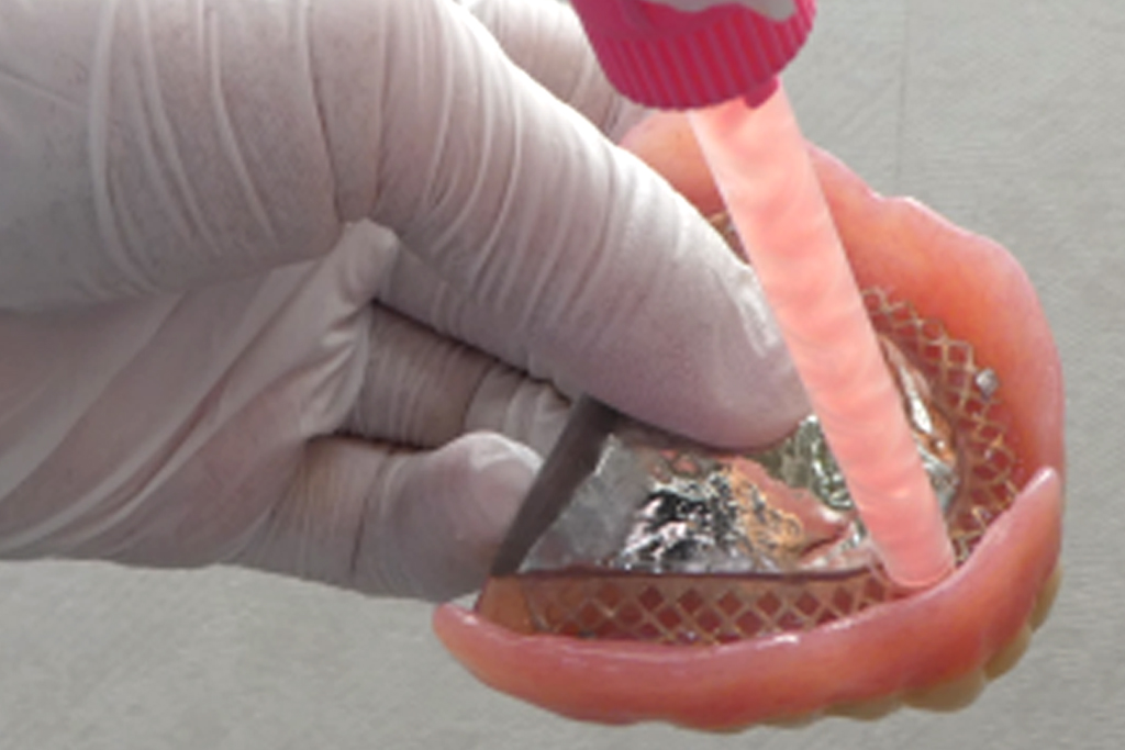 薬円台・古池歯科・現在の入れ歯の内面に軟質リライン材を加工